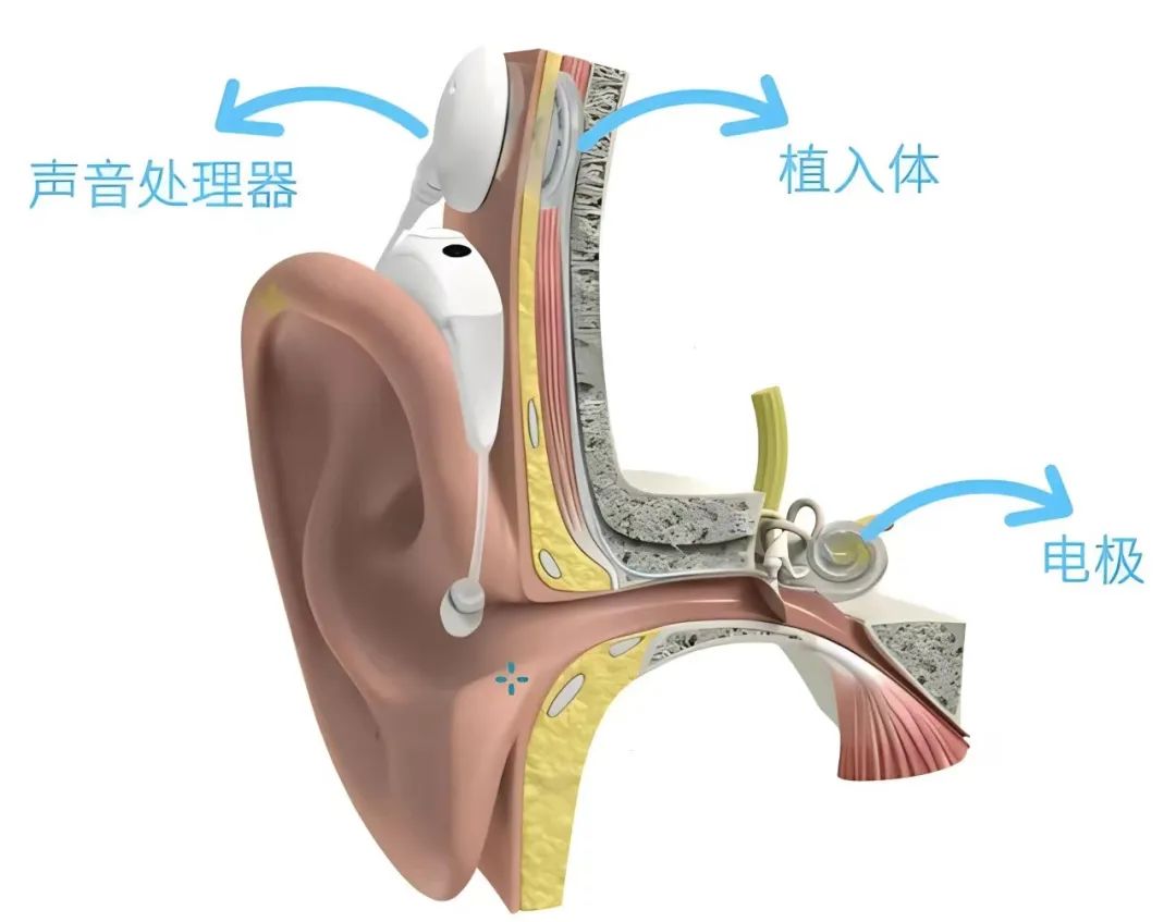 人工耳蝸技術革新突破聽覺障礙壁壘，開啟嶄新篇章