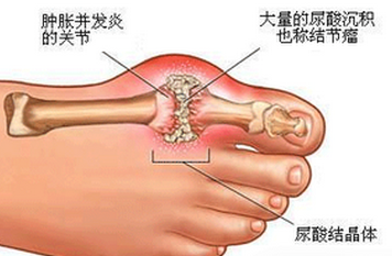 痛風最新治療進展與策略綜述